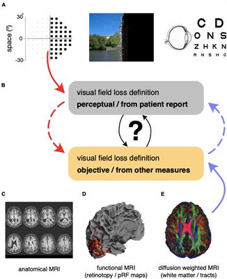 Linking Multi-Modal MRI to Clinical Measures of Visual Field Loss After Stroke